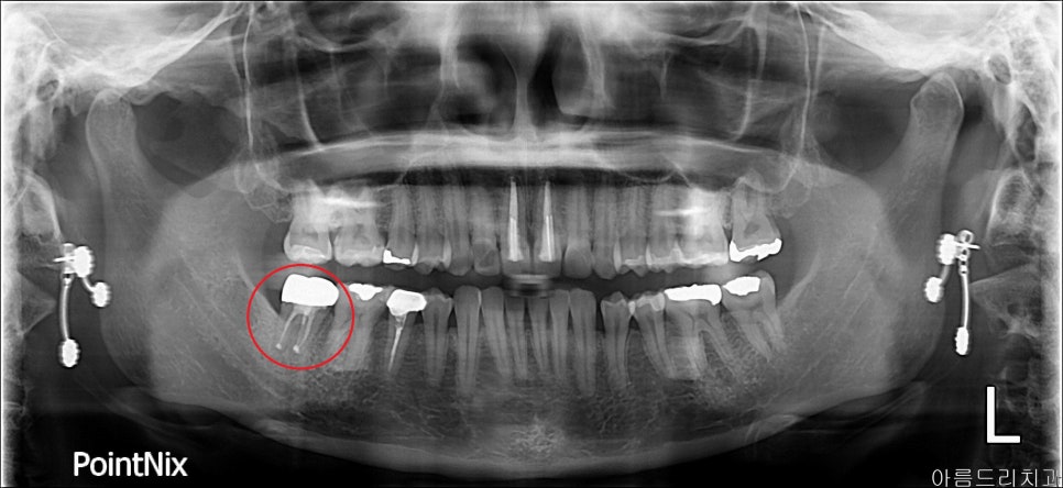 [신논현 치과] 임플란트 대신 치아재식(아름드리치과) 관련 이미지 12