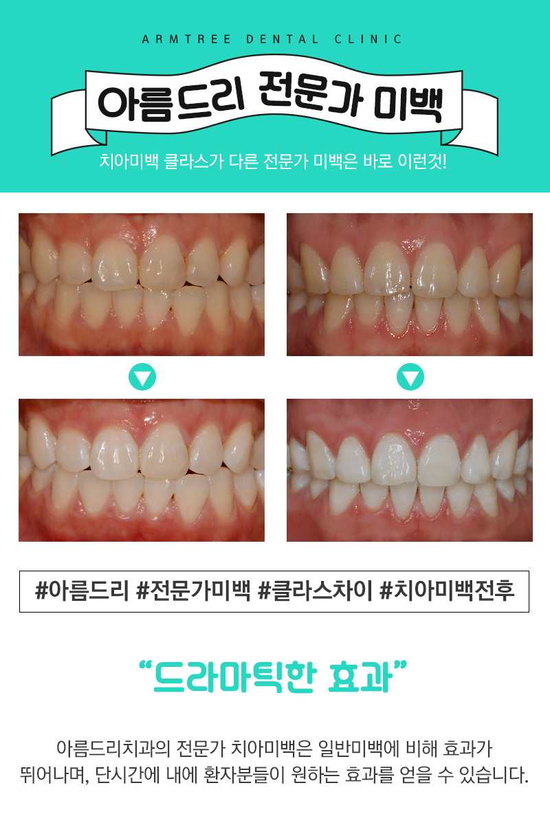 강남역 치아미백 상식 바로잡자 관련 이미지 7