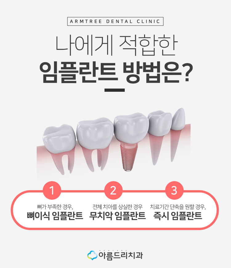 네비게이션임플란트 부작용은 저리가 관련 이미지 3