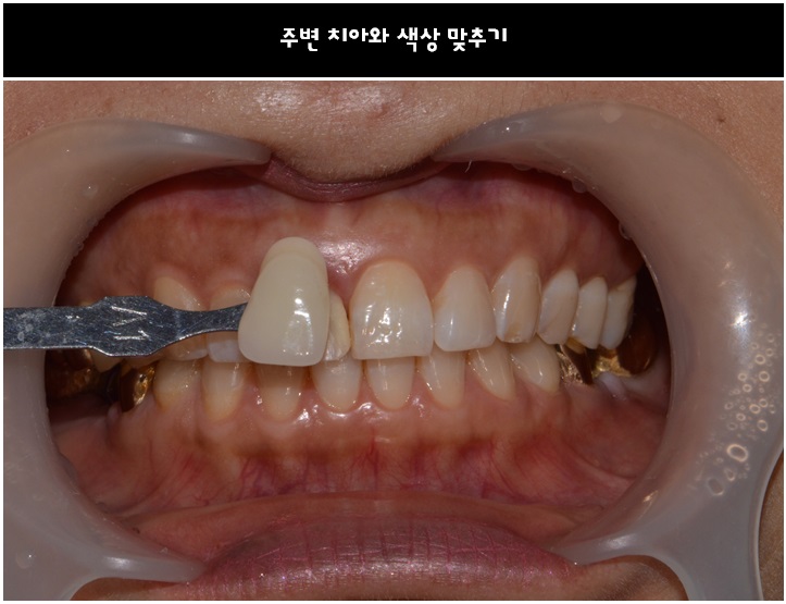 앞니 올세라믹 _재시술 (잇몸변색,메탈노출) 관련 이미지 5