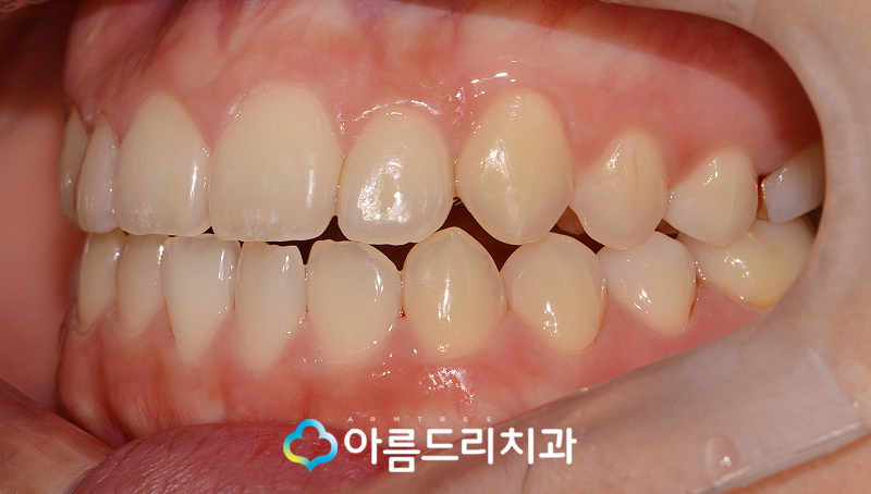 덧니부분교정 앞니 이런후기만 관련 이미지 10