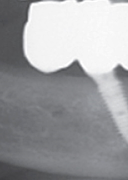 반포치과 전악임플란트는 풀아치 임플란트로 관련 이미지 11