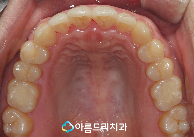 투명교정장치 인비절라인 치과 후기 관련 이미지 12