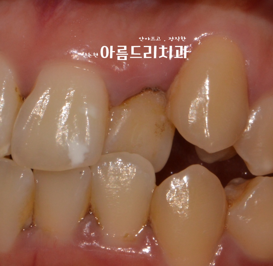 덧니 교정, 악궁 확장장치, 쁘띠 교정_신논현역 아름드리치과 관련 이미지 10