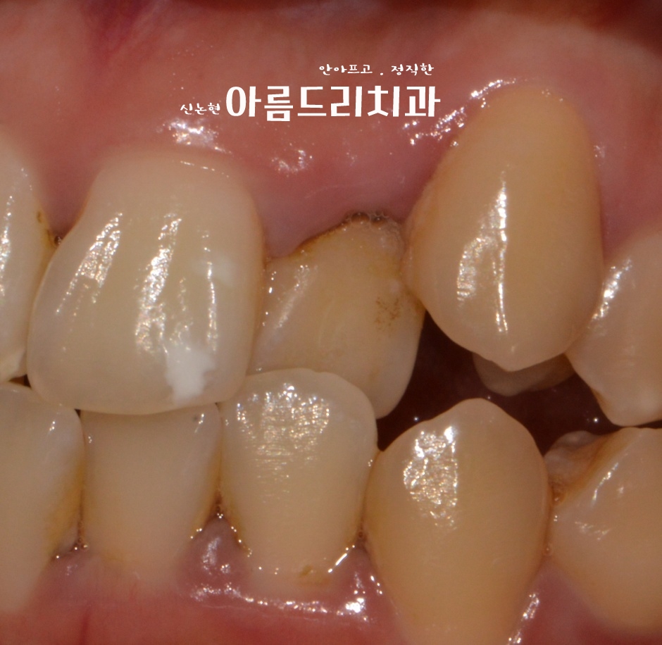 덧니 교정, 악궁 확장장치, 쁘띠 교정_신논현역 아름드리치과 관련 이미지 11
