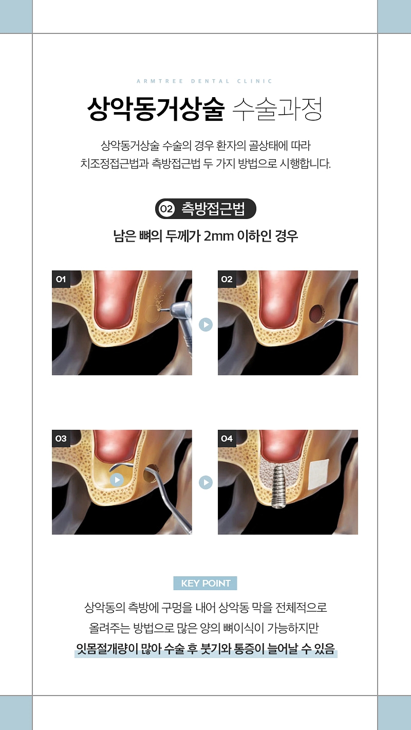 상악동거상술 부작용없는 아름드리치과 관련 이미지 5