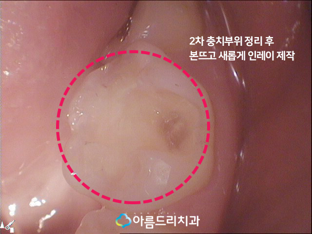 치아우식증 치료 증상과 예방법 관련 이미지 8