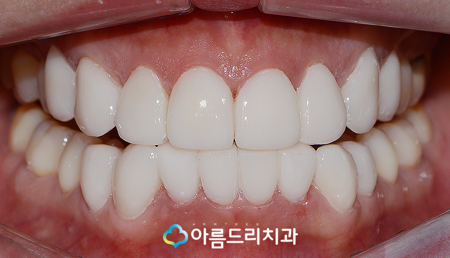 치아라미네이트 삭제량이 초중요 관련 이미지 9