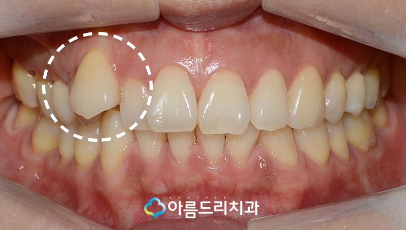 드라큘라이빨 송곳니교정 부분교정후기 관련 이미지 3