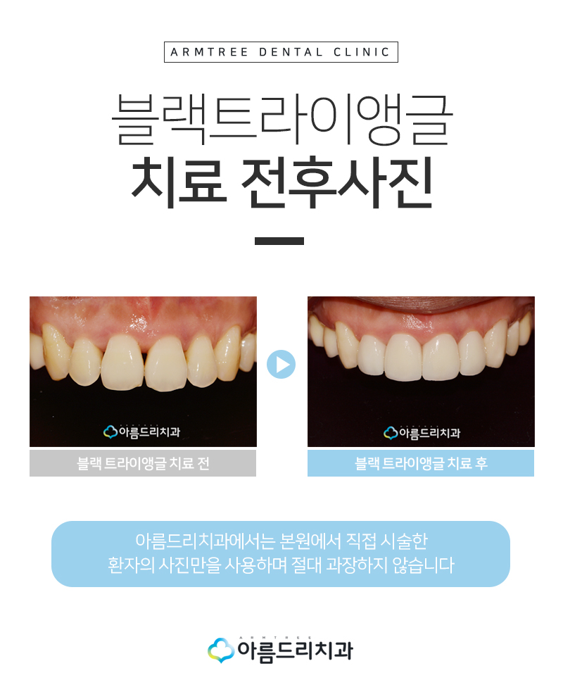 앞니블랙트라이앵글 치료 치아 후기 관련 이미지 9