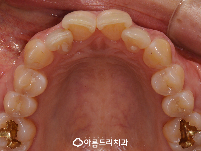 앞니돌출 앞니돌출교정 치과 아름드리 관련 이미지 3