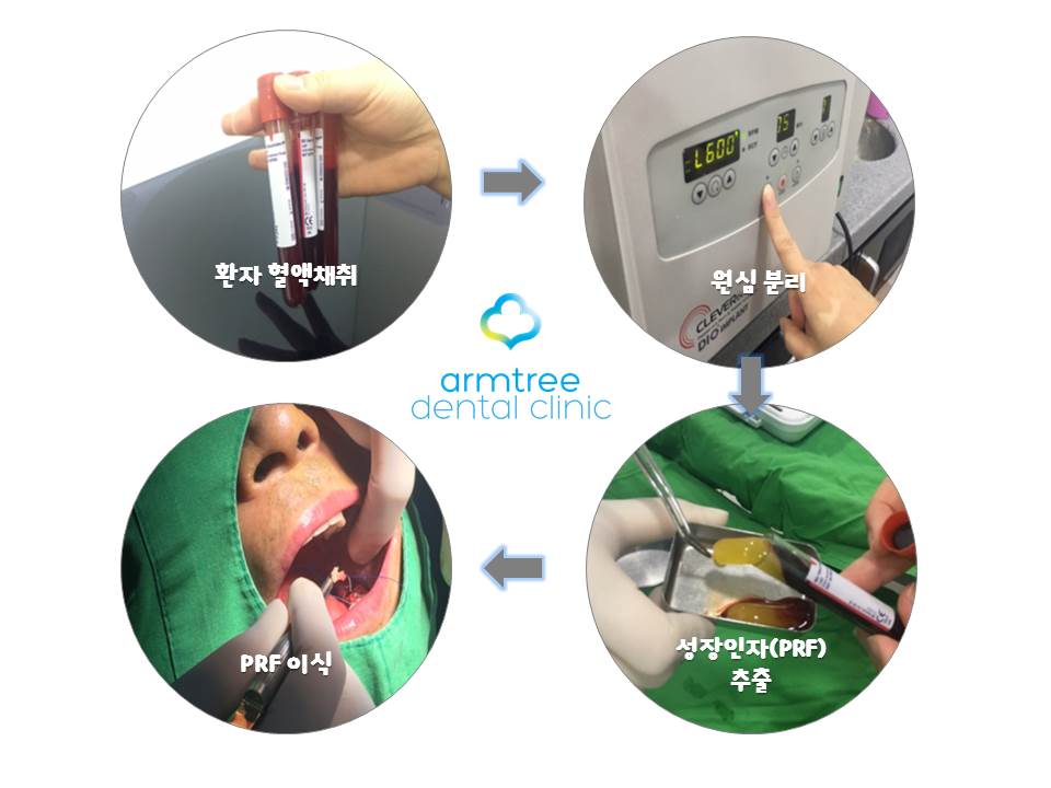 신논현역치과 PRF 자가혈 임플란트. 안전한 임플란트_아름드리 치과 관련 이미지 2