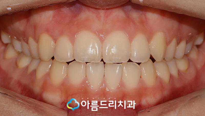 덧니부분교정 앞니 이런후기만 관련 이미지 8
