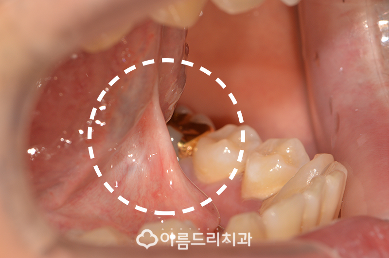 성인설소대수술 혀유착증 강남 바로알기 관련 이미지 4