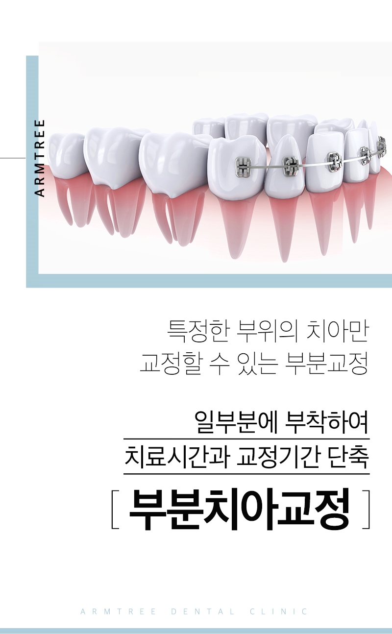 부분교정기간 신중하게 아름드리치과 관련 이미지 2