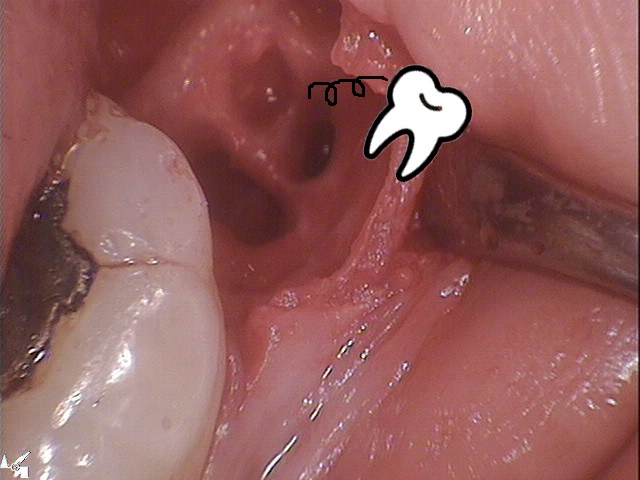 강남 아름드리치과 수술 발치_매복치 신논현치과 관련 이미지 6