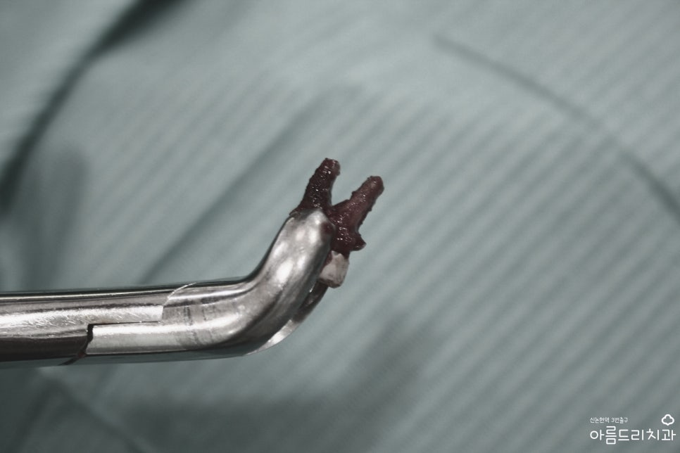 치아재식_임플란트 안 하고 치아 살릴 순 없나요?(신논현역 치과) 관련 이미지 5
