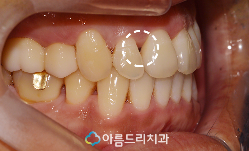 앞니블랙트라이앵글 치료 치아 후기 관련 이미지 4