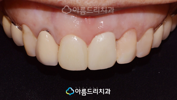 치아탈구(깨짐) 앞니임플란트 지르코니아어버트먼트 관련 이미지 9
