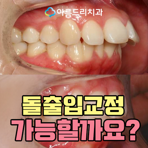 입툭튀교정 돌출앞니 환자후기 관련 이미지 1