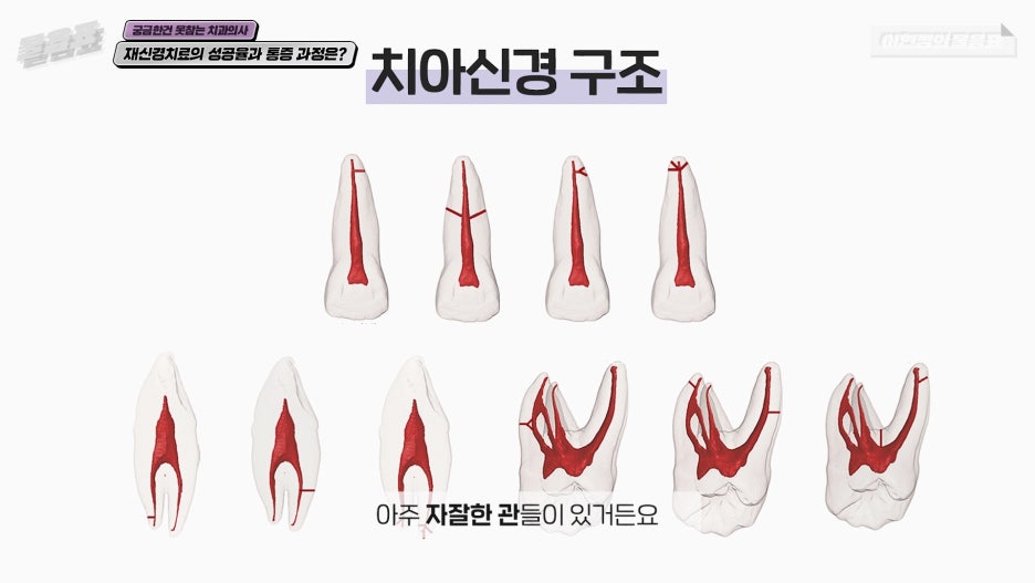 치아 재신경치료 성공율 과정과 통증 #이현정의물음표 관련 이미지 6