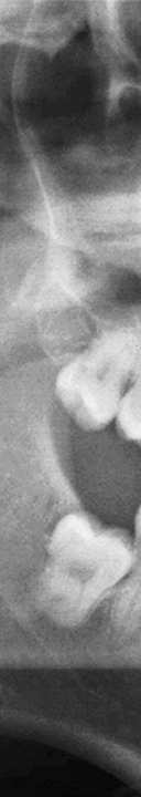 신논현역치과 사랑니 발치를 원한다면 관련 이미지 6