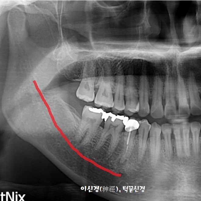 재신경치료_다시하는 신경치료 _기둥(post) 제거하기 관련 이미지 4