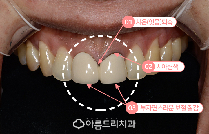 실활치미백 치은 잇몸퇴축 재생으로 동안치아 관련 이미지 3