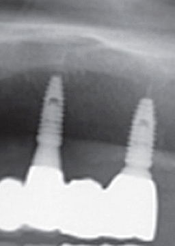 반포치과 전악임플란트는 풀아치 임플란트로 관련 이미지 8