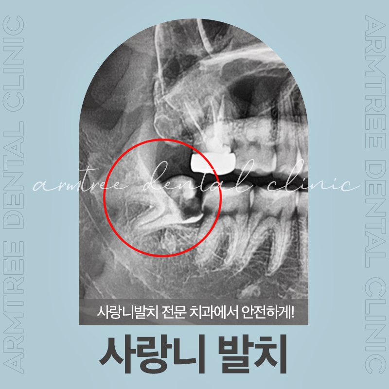 신논현 사랑니발치치과 선택은 신중해야만 관련 이미지 1