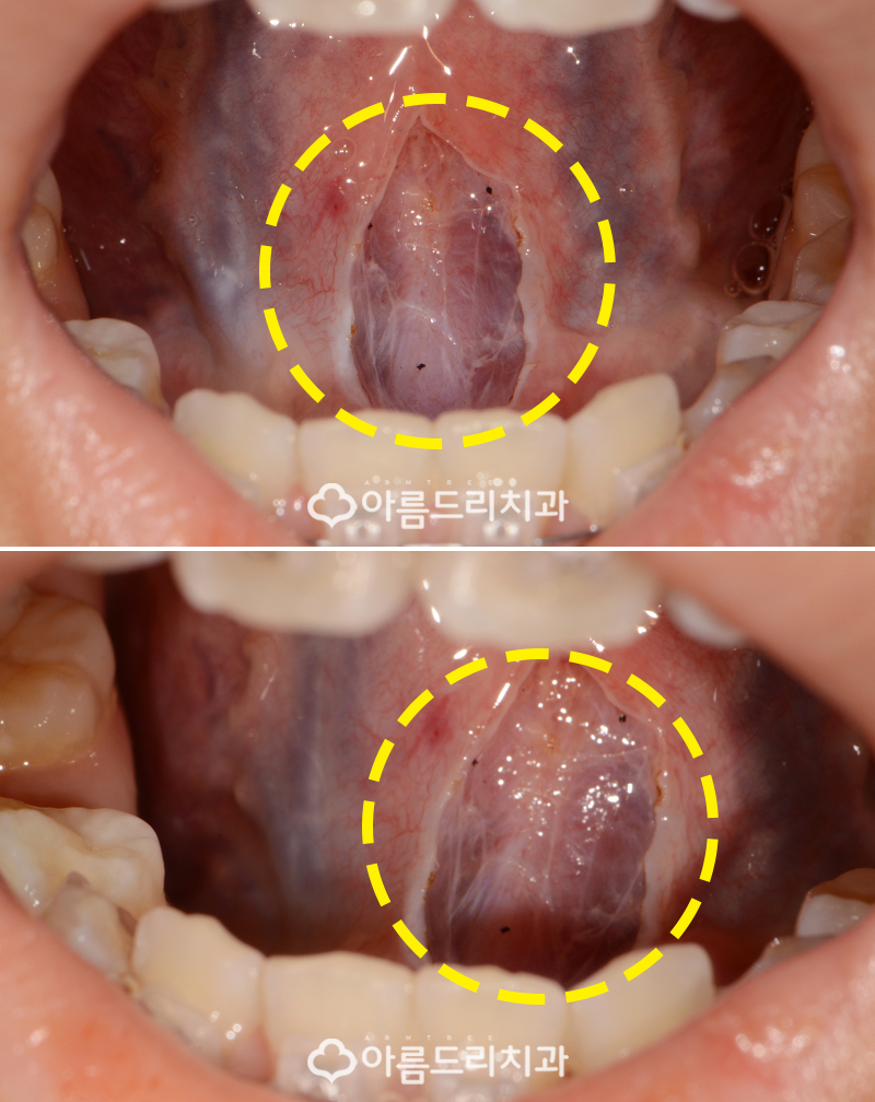 성인설소대수술 단축증 비용과 후기 관련 이미지 6