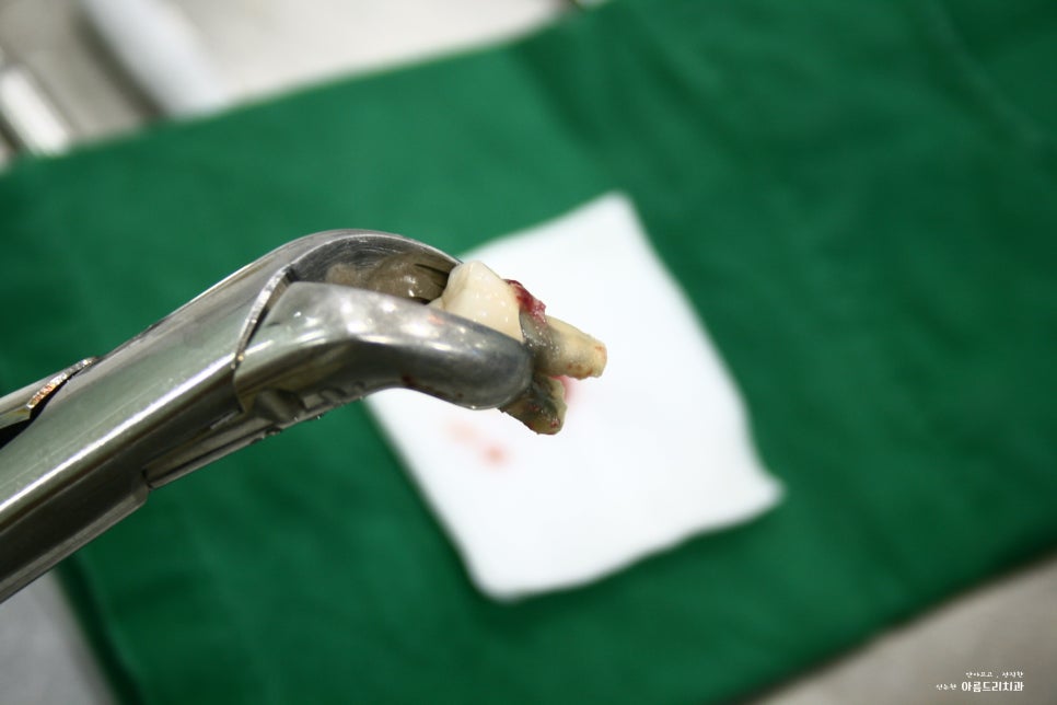 치아재식_임플란트 안 하고 치아 살릴 순 없나요?(신논현역 치과) 관련 이미지 19