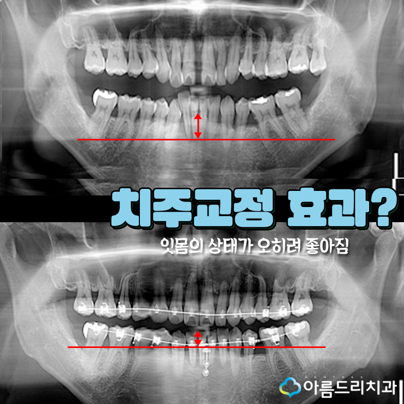 부분교정치과 후기 성인치주교정 관련 이미지 5