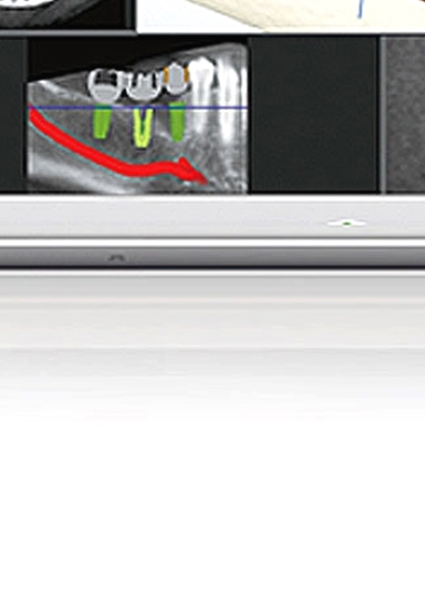 디지털임플란트 당일임플란트로 정확하고 안전하다면 관련 이미지 12