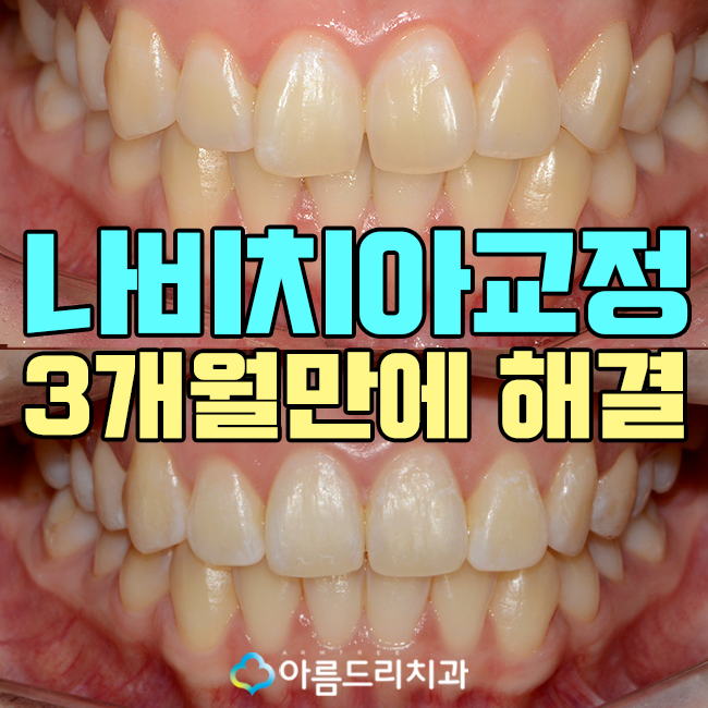 나비치아 교정 앞니 부분교정 후기 관련 이미지 1