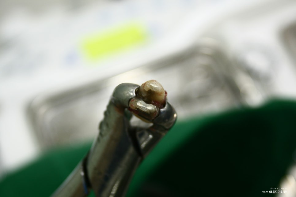 치아재식_임플란트 안 하고 치아 살릴 순 없나요?(신논현역 치과) 관련 이미지 18