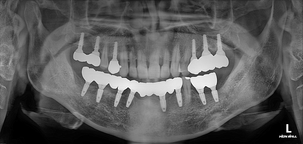 부분교정+임플란트(진료일기) 관련 이미지 8