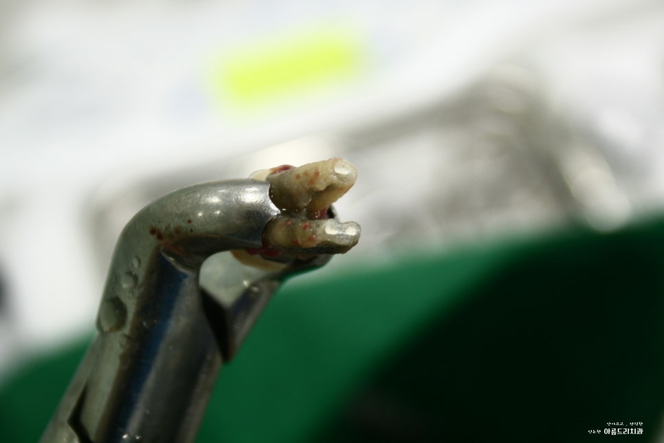 치아재식_임플란트 안 하고 치아 살릴 순 없나요?(신논현역 치과) 관련 이미지 17