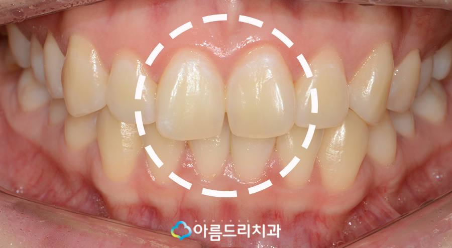 나비치아 교정 앞니 부분교정 후기 관련 이미지 3