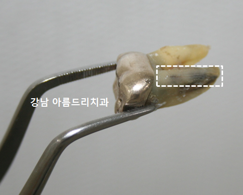 치아 통증은 있는데 이상은 없다?(재식, 임플란트_아름드리 치과) 관련 이미지 1