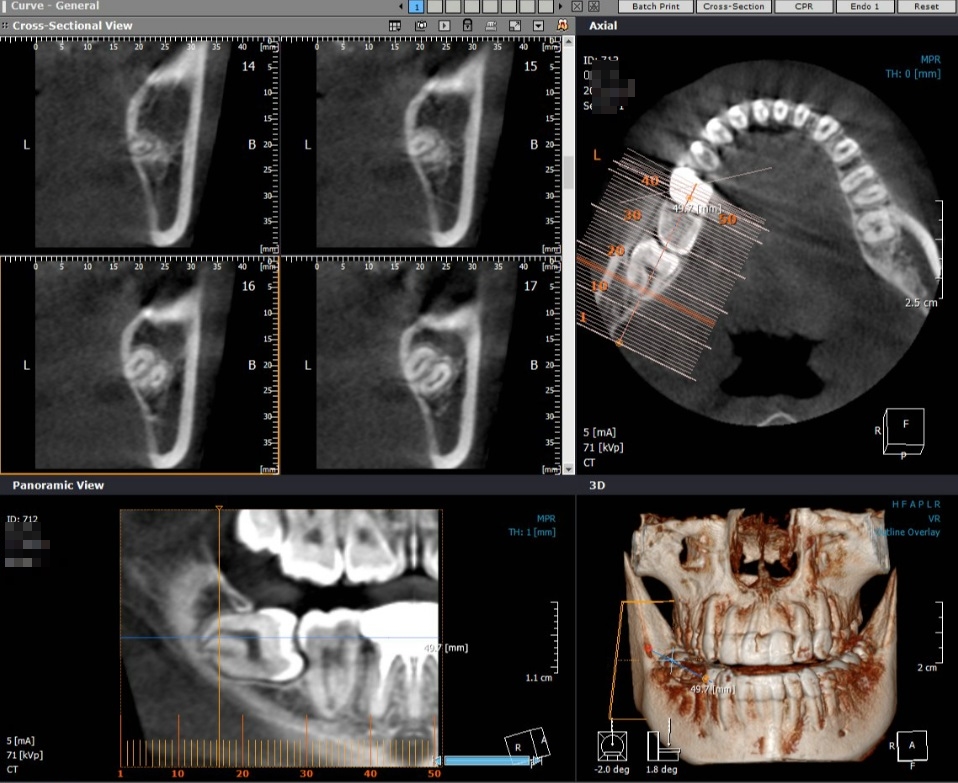 [신논현치과]사랑니 발치_수술발치_매복치_아름드리치과 관련 이미지 5