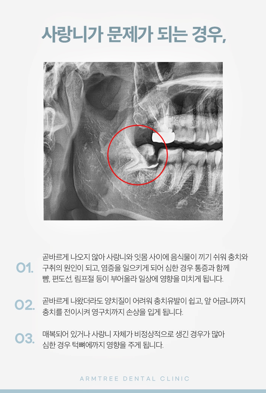 신논현 사랑니발치치과 선택은 신중해야만 관련 이미지 4