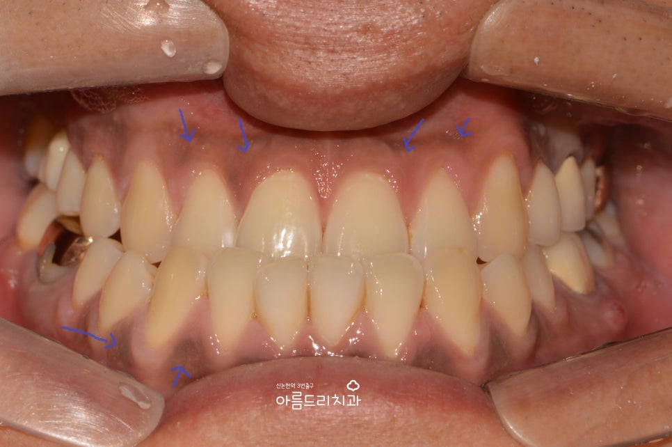 검은 잇몸! 잇몸미백으로 선홍빛 깨끗하게 관련 이미지 6
