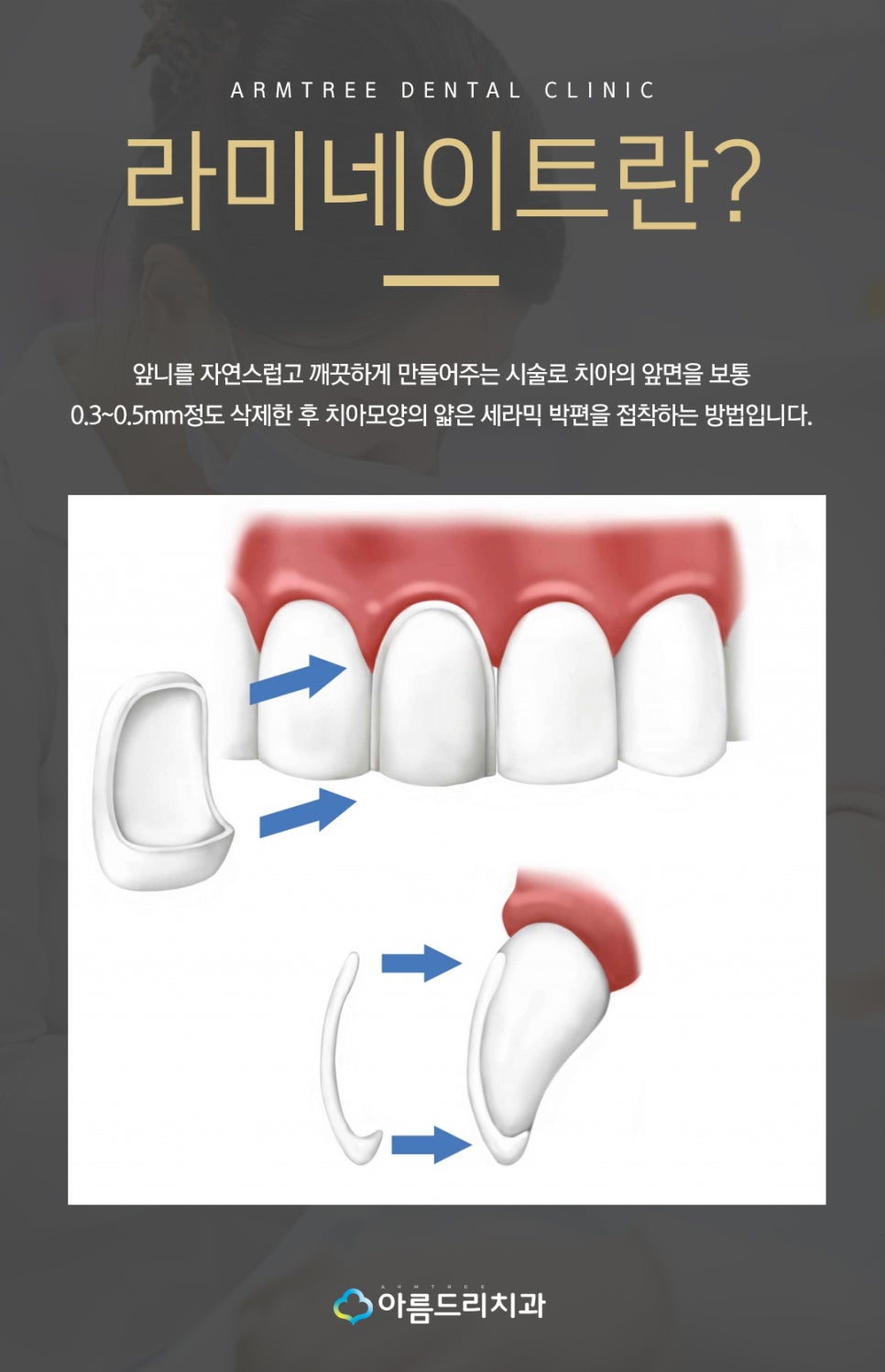 라미네이트연예인 이빨(치아) 최소삭제 이거다 관련 이미지 7