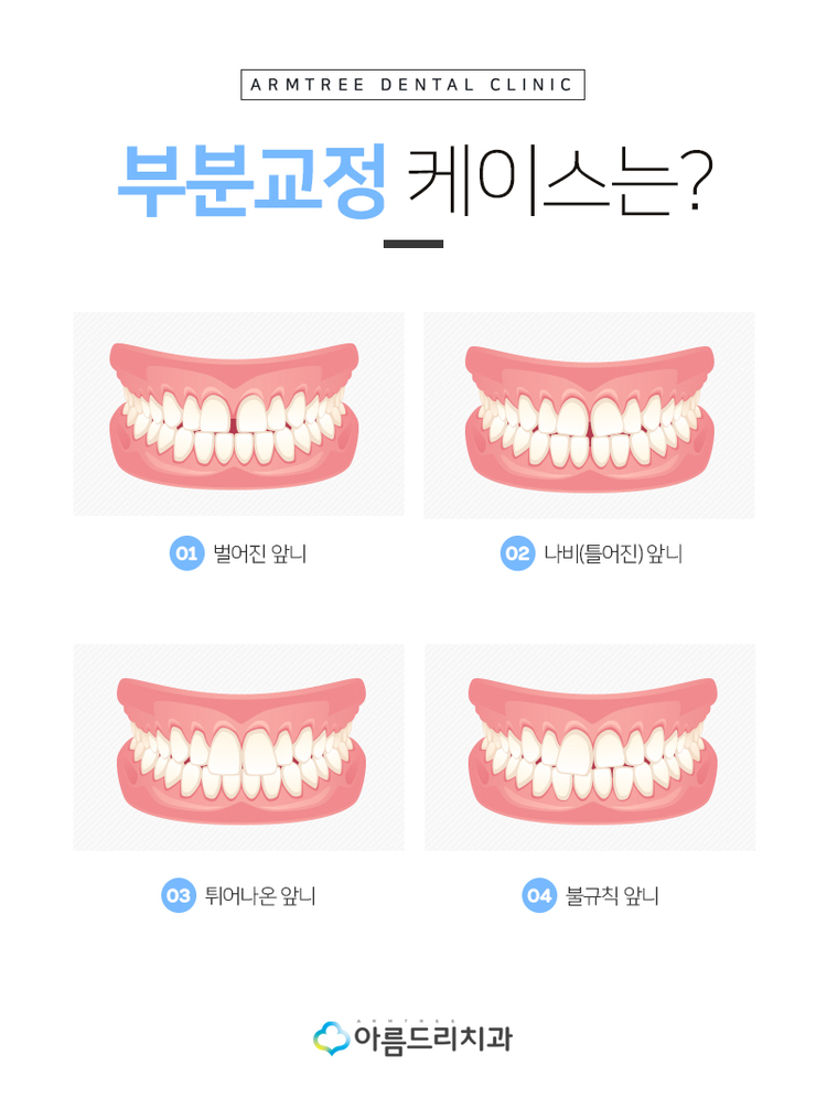 부분치아교정 틀어진앞니 후기역시 관련 이미지 6
