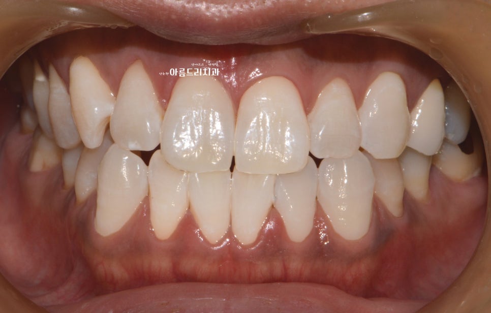 치아미백 효과부터 그 후 모든 것_치과 미백_자가미백 관련 이미지 5