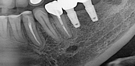 신논현역임플란트 아름드리치과에서 상악동거상술이 필요하면 관련 이미지 15