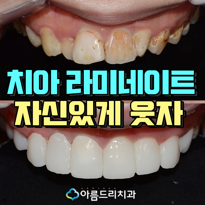 치아라미네이트 후기보며 활짝웃자 관련 이미지 1