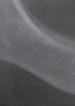 반포치과 전악임플란트는 풀아치 임플란트로 관련 이미지 10