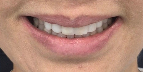 테일러 비니어 (진료일기) 관련 이미지 13